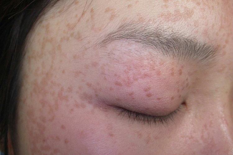 扁平疣颞部症状图