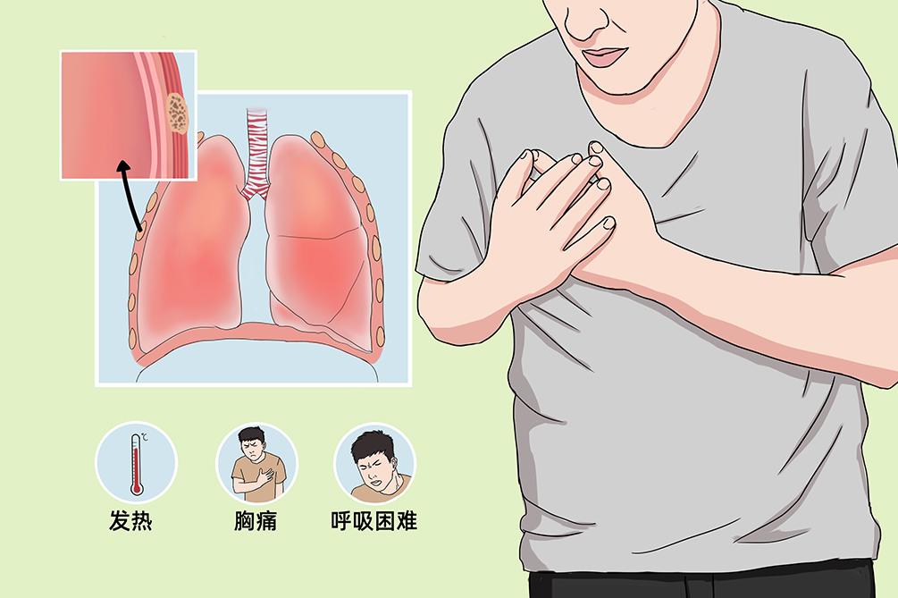 胸膜炎胸痛特点和位置图片
