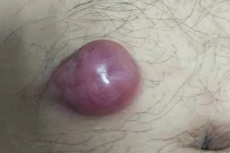隆突性皮肤纤维肉瘤右腹症状图