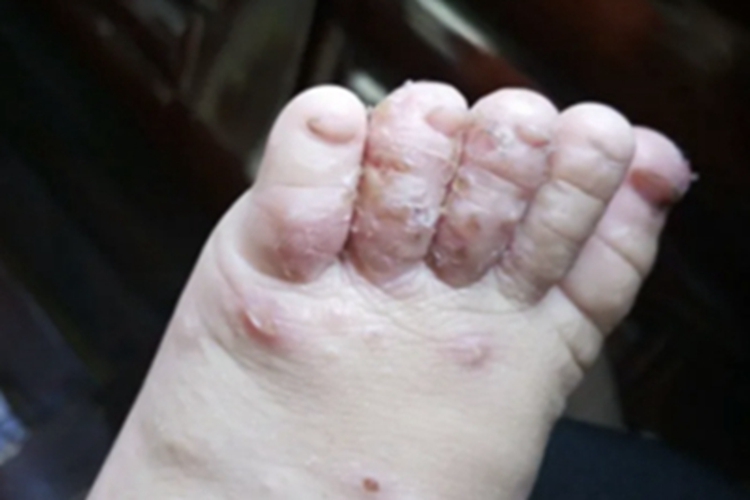 急性湿疹脚部水疱图