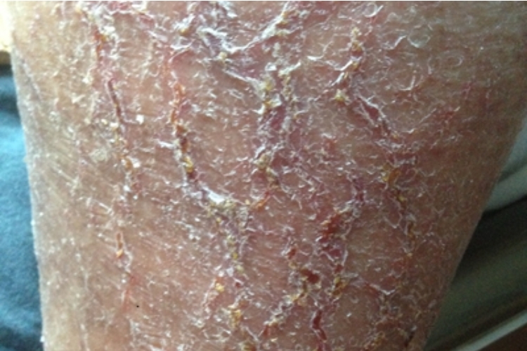 皲裂性湿疹小腿粗糙裂纹深图