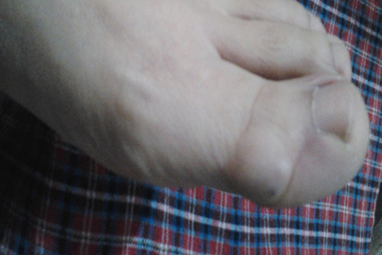 脚趾头关节腱鞘囊肿图