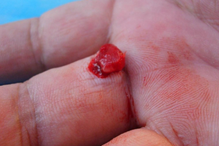 毛发肉芽肿手掌症状图