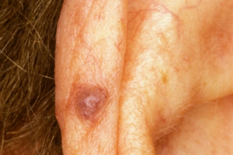 静脉湖耳廓小疙瘩图 静脉湖耳廓小疙瘩图