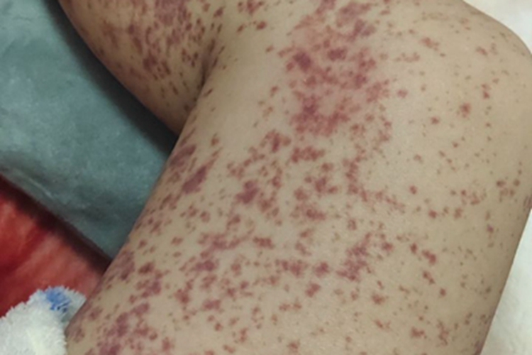 单纯性紫癜腿部症状图