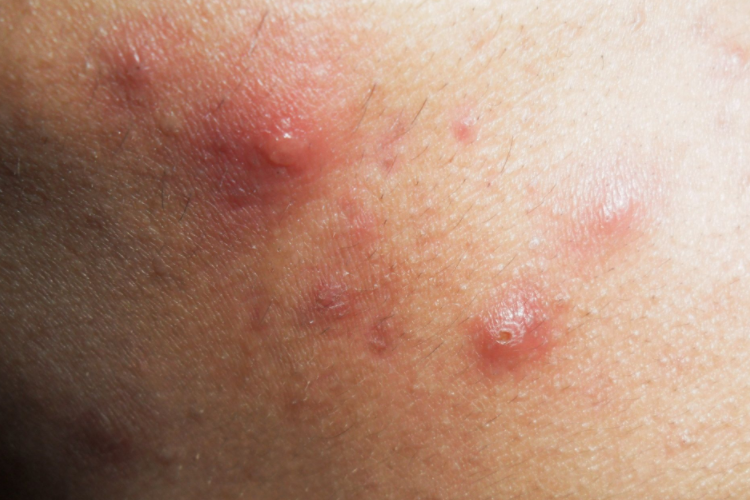 典型皮损是境界清楚的红斑,其上有丘疹与丘疱疹,严重时红肿明显并出现