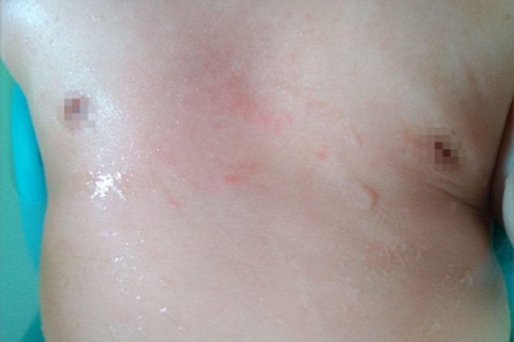 渗出型婴儿湿疹胸部症状图