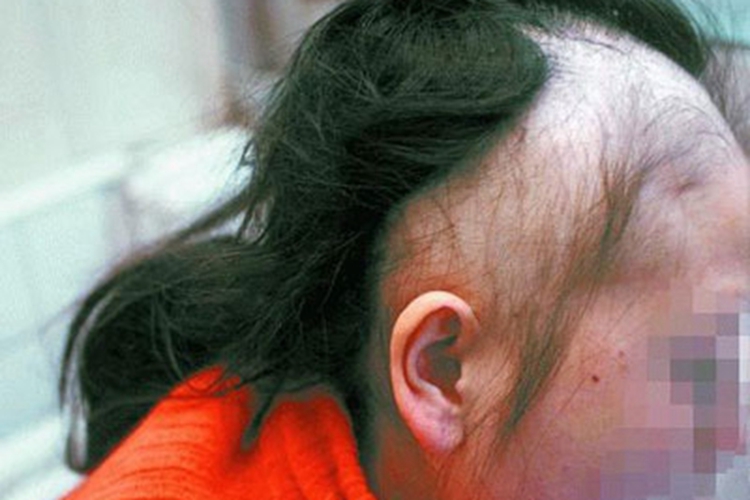 急性铊中毒头皮症状图