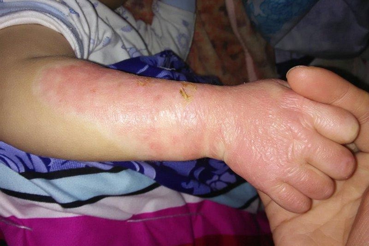 烫伤创面结痂图