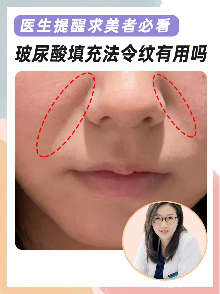 医生提醒求美者必看:玻尿酸填充法令纹有用吗
