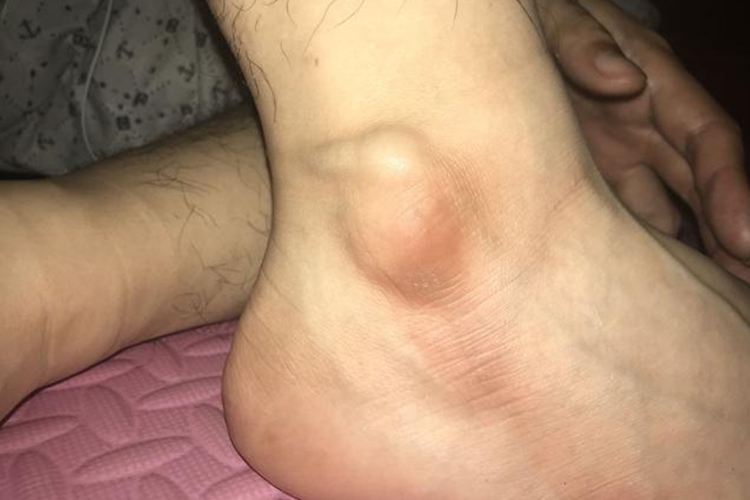 脚踝脂肪瘤图 脚踝脂肪瘤图