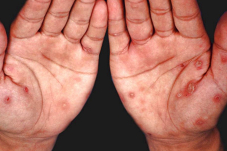 三期梅毒手掌溃疡图