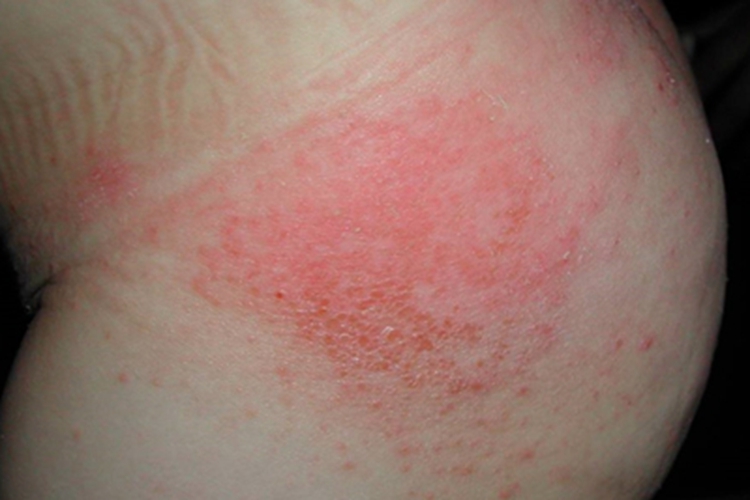 婴儿尿布疹臀部症状图