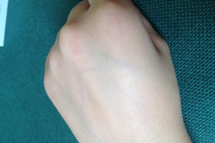 有表皮正常皮肤图