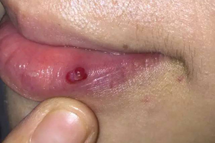 化脓性肉芽肿嘴唇水疱图