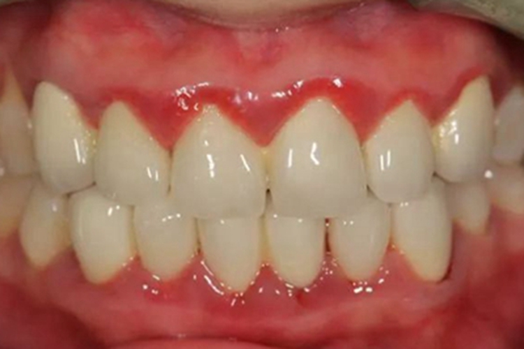 牙龈萎缩牙龈肿胀像要出血图