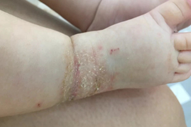 干性湿疹脚部症状图