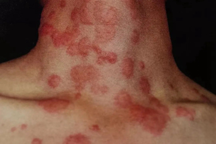 急性发热性嗜中性皮病颈部症状图 急性发热性嗜中性皮病颈部症状图