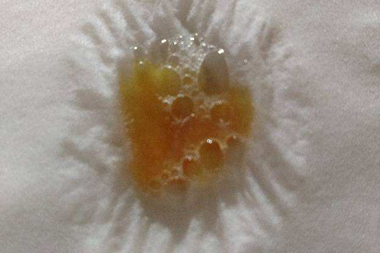 肺部恶性肿瘤脓性痰液图