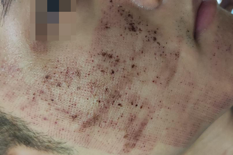 点阵激光后结痂图