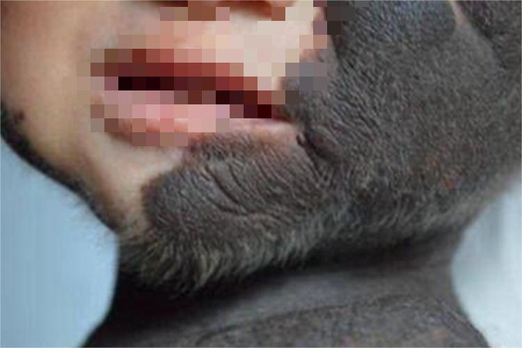 兽皮痣面部症状图