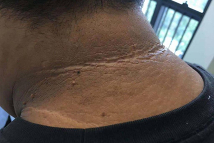 假性黑棘皮病症状图