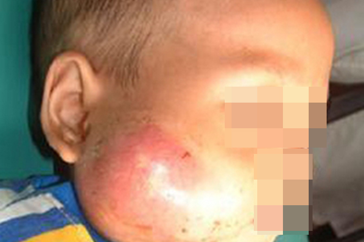 儿童复发性腮腺炎红肿图