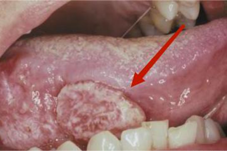 口腔癌舌头肿块图
