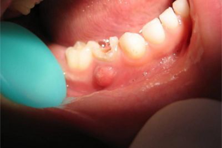 牙槽脓肿小红疙瘩图