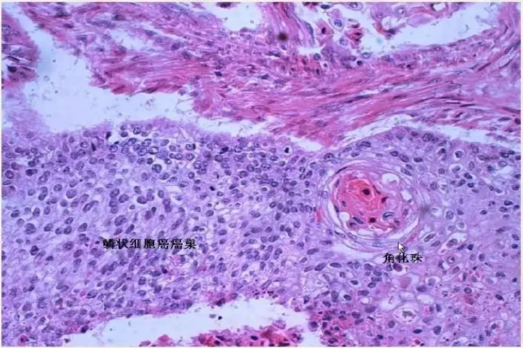 食道鳞状细胞癌细胞图