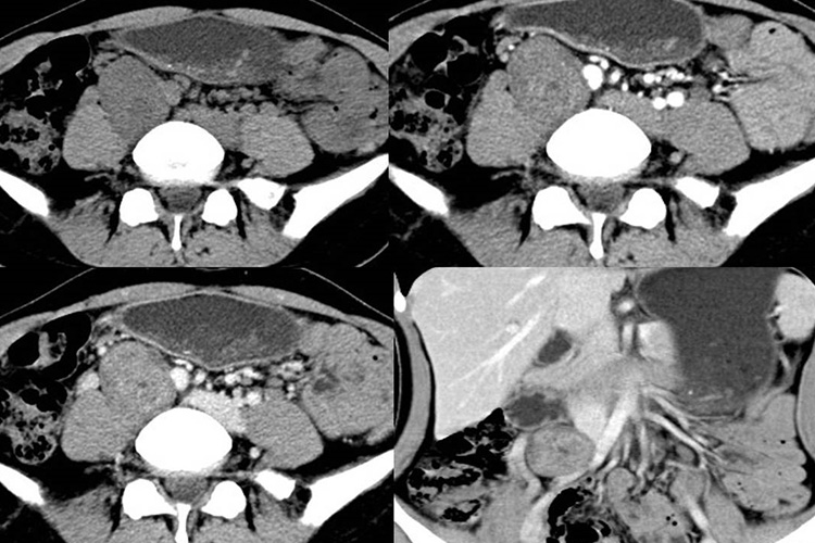 平滑肌肉瘤的CT图