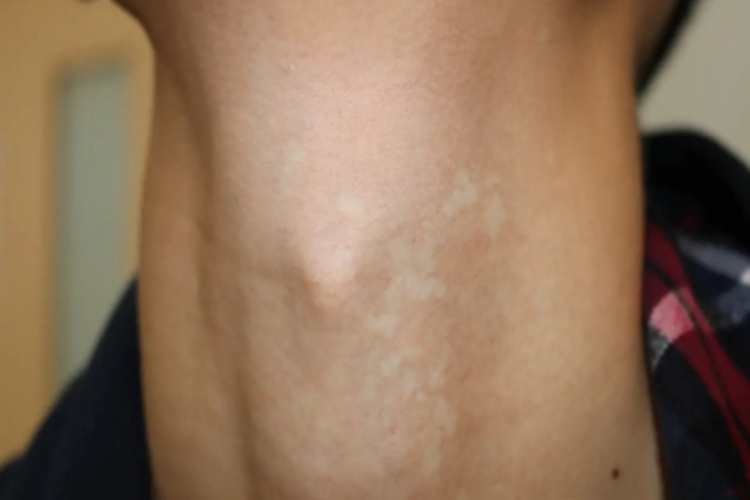 无色素痣前颈症状图