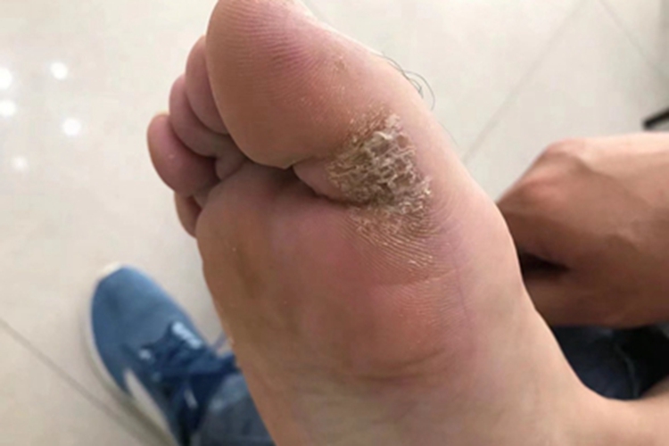 慢性湿疹脚部症状图