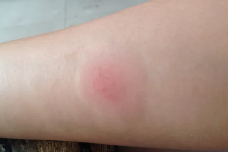 结核菌素试验阳性图