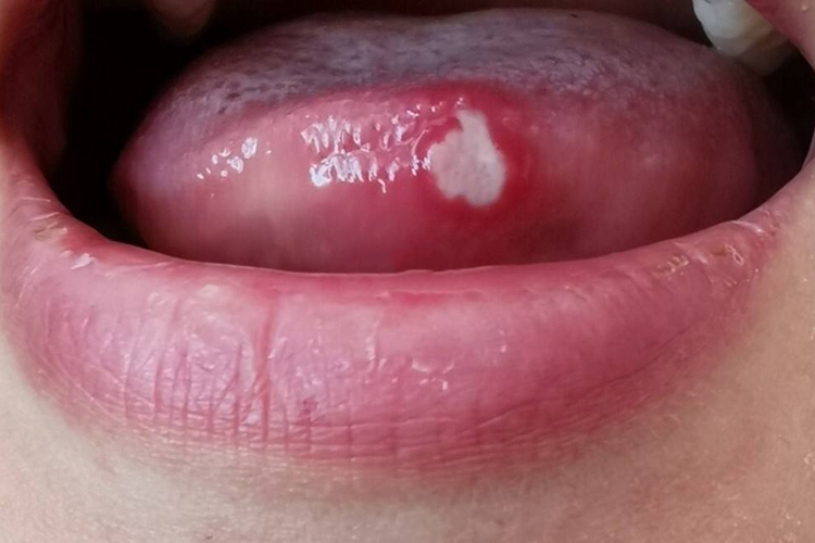 重型阿弗他溃疡图