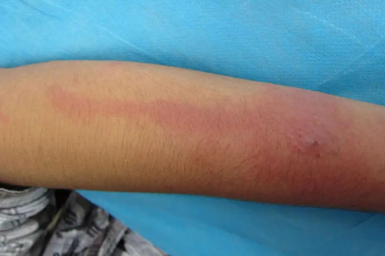 网状淋巴管炎片状红斑图