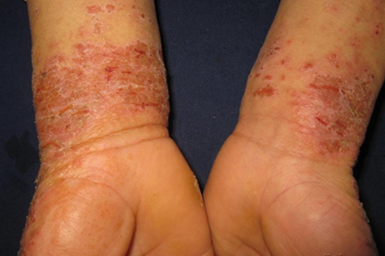 职业性光变应性接触性皮炎手腕结痂图 职业性光变应性接触性皮炎手腕结痂图