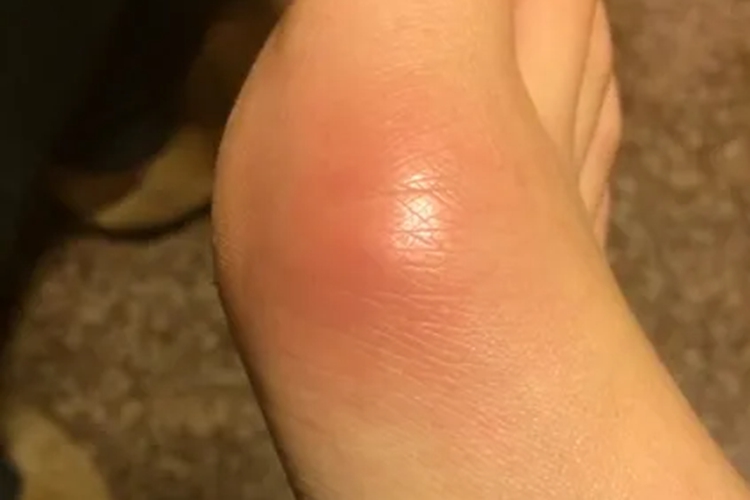 脚内侧软组织损伤图