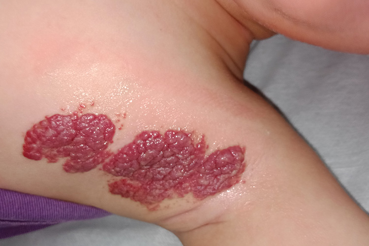 草莓状血管瘤图 草莓状血管瘤图