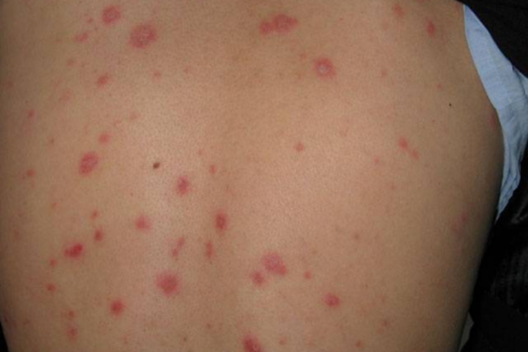 色素性紫癜性皮病背部斑图