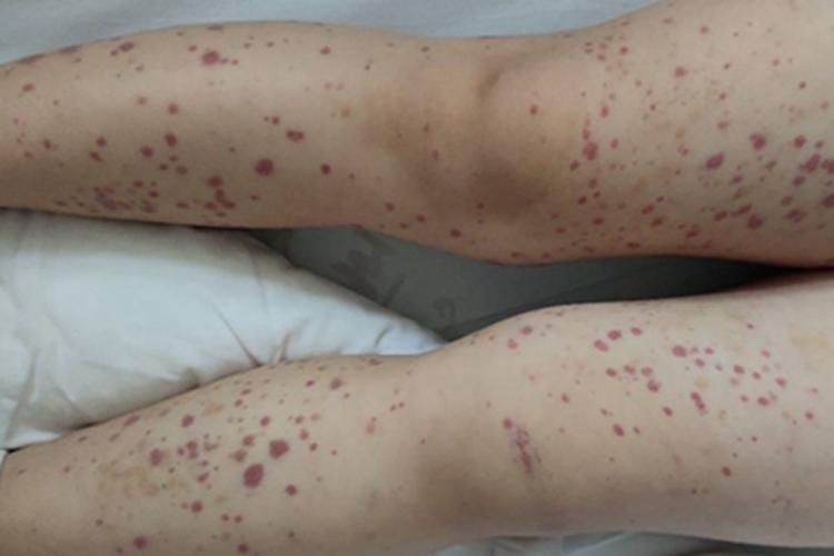 小儿过敏性紫癜腿症状图 小儿过敏性紫癜腿症状图