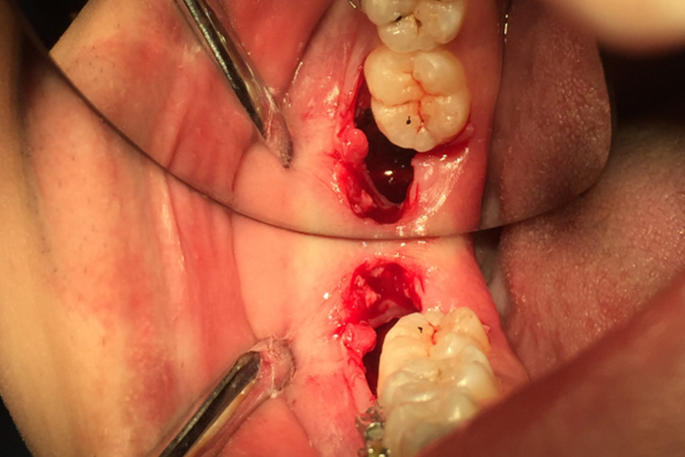 拔完智齿正常的伤口图 拔完智齿正常的伤口图