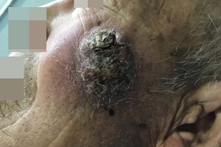 基底细胞瘤面部症状图