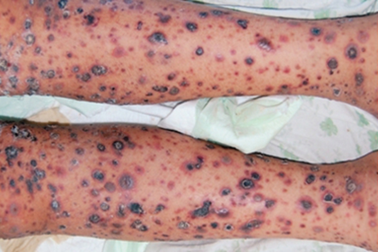 发热溃疡坏死性苔藓样糠疹黑痂图 发热溃疡坏死性苔藓样糠疹黑痂图