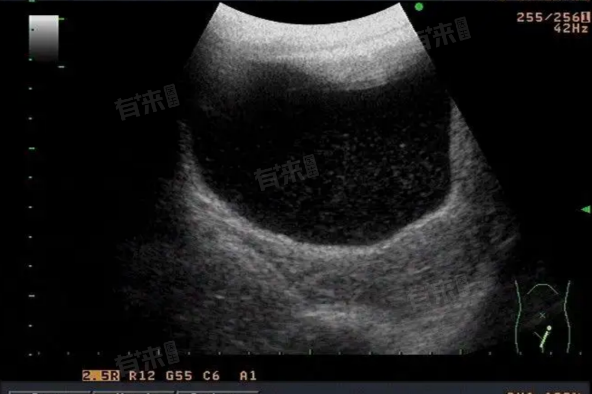 做子宫彩超需要憋尿吗-有来医生