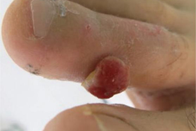 肉芽肿型血管瘤脚趾症状图 肉芽肿型血管瘤脚趾症状图