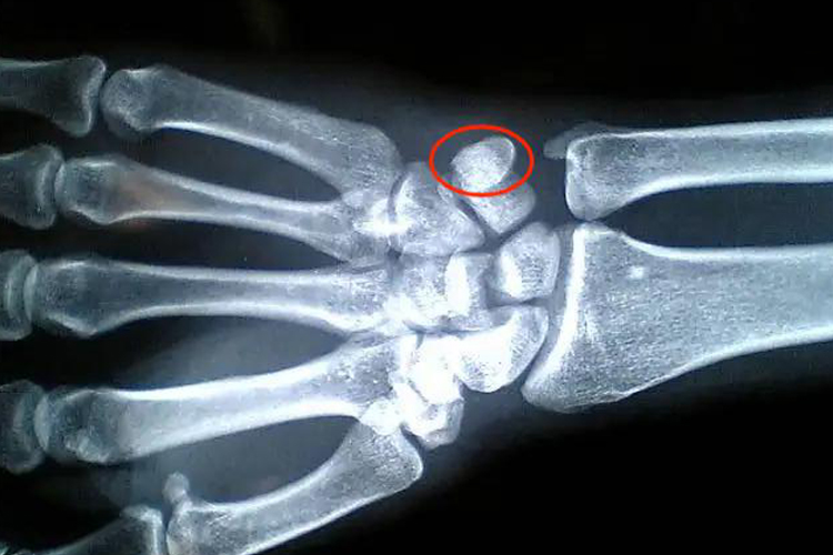 手腕豆状骨影像图