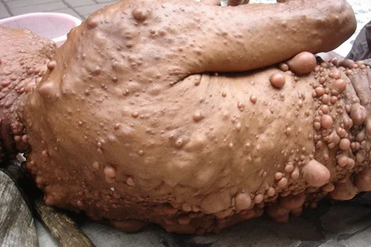 皮肤纤维瘤身上长瘤子疙瘩图