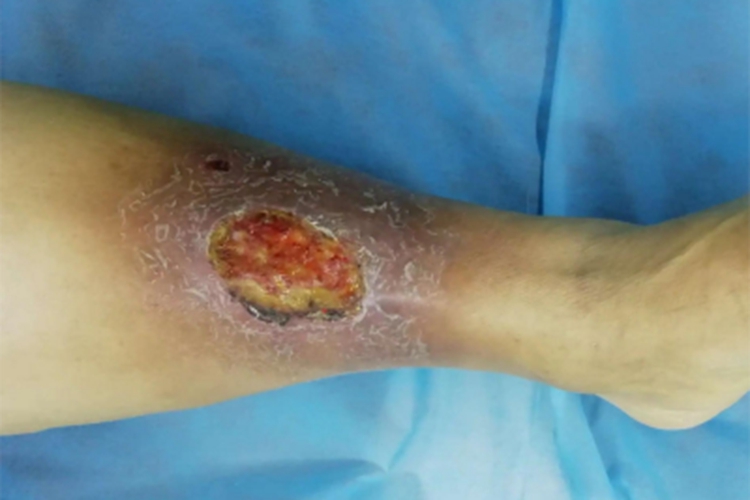 臁疮小腿症状图 臁疮小腿症状图