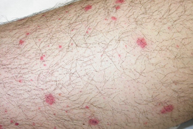 花斑糠疹小腿红点图 花斑糠疹小腿红点图